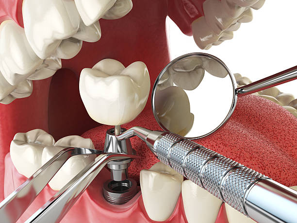 Best Urgent Care for Lost Fillings or Crowns in Metzger, OR